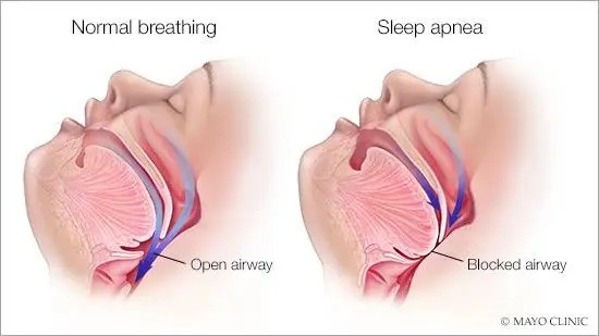 What Happens To Your Body During Obstructive Sleep Apnea