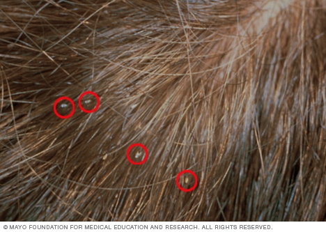 Medical Monday: Debunking Myths About Head Lice